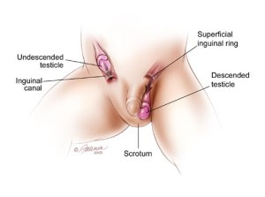 undescended testes
